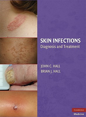 Skin Infections Diagnosis and Treatment