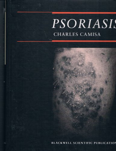 Psoriasis